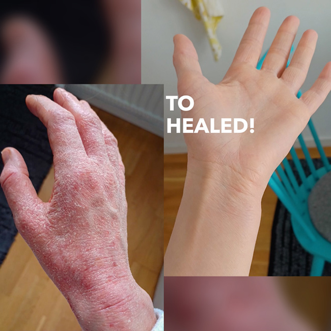 I Finally Healed My Eczema Thanks To This Information