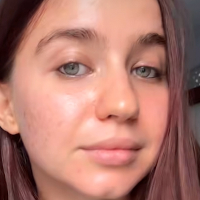 Incredible 10 Month Acne Progress